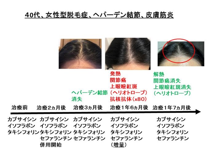 円形脱毛症　病院